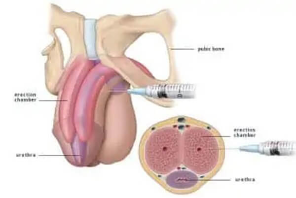 PRP-P-Shot-Tedavisi adıyaman