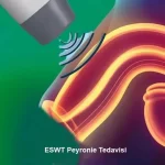 Adıyaman Peyronie hastalığı tedavisi